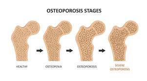 osteoporosis